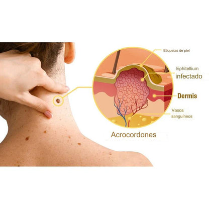 Tratamiento en aerosol contra las VERRUGAS TagRecede